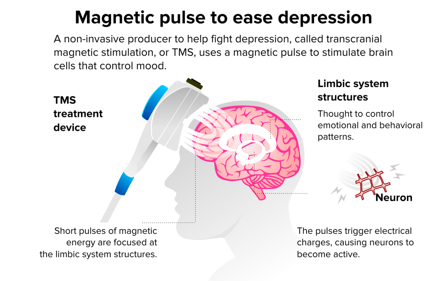 Repetitive Transcranial Magnetic Stimulation rTMS Brunswick Private 
